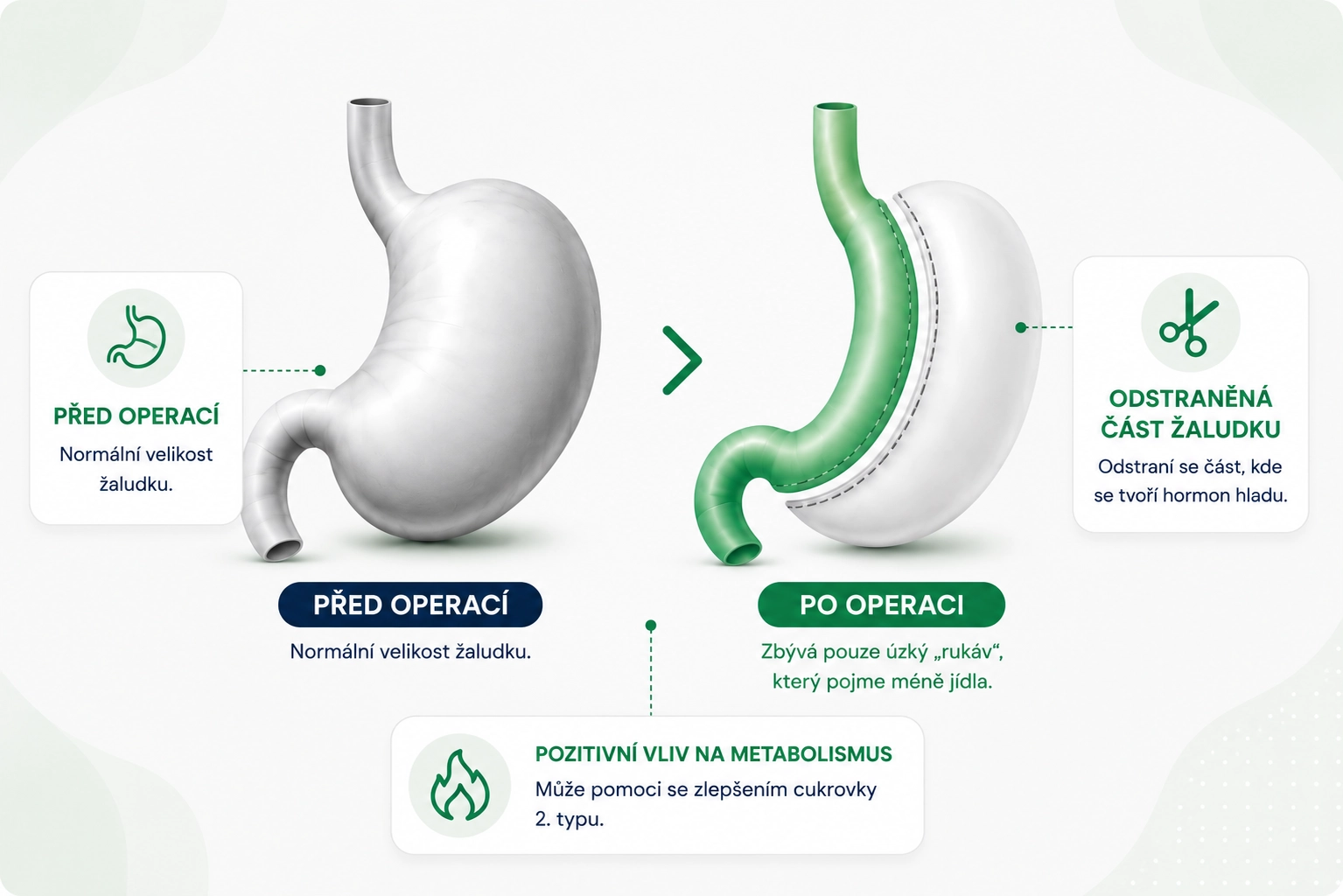 Sleeve Gastrectomy